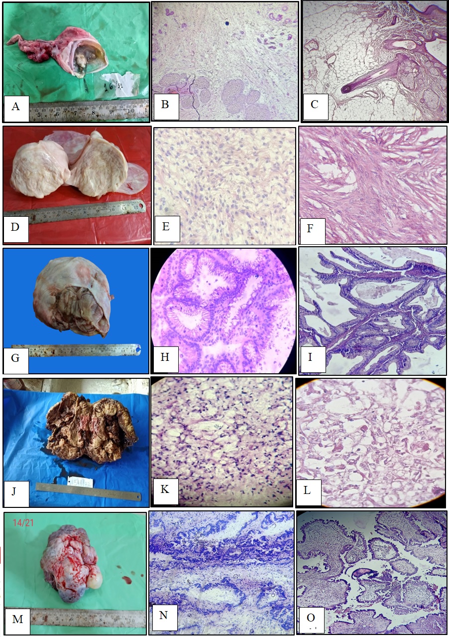PDF) Factors associated with misdiagnosis of frozen section of mucinous  borderline ovarian tumor